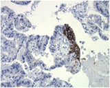 小切片胃癌样本显示单小点免疫作用肿瘤细胞