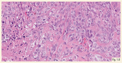 CM69-ESMO-Sarcoma-Fig1-8